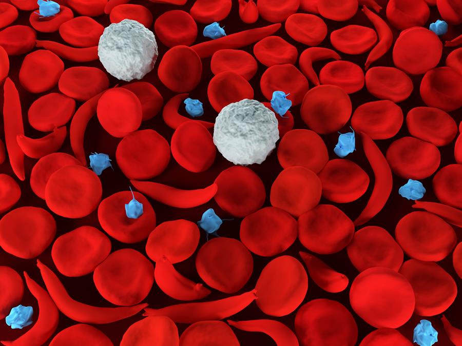 Drépanocytose : une maladie encore trop méconnue en Belgique