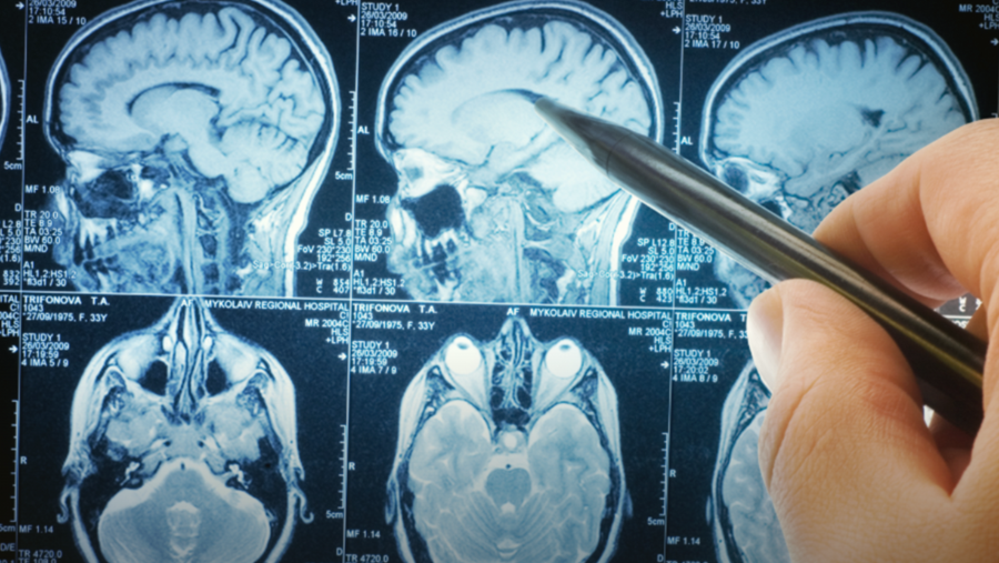 La mutation d'un gène affaiblit la défense immunitaire du cerveau